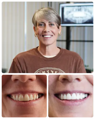 E-max Veneers transformation — Brittney Salisbury